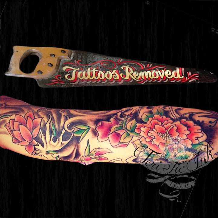 Tattoos_removed